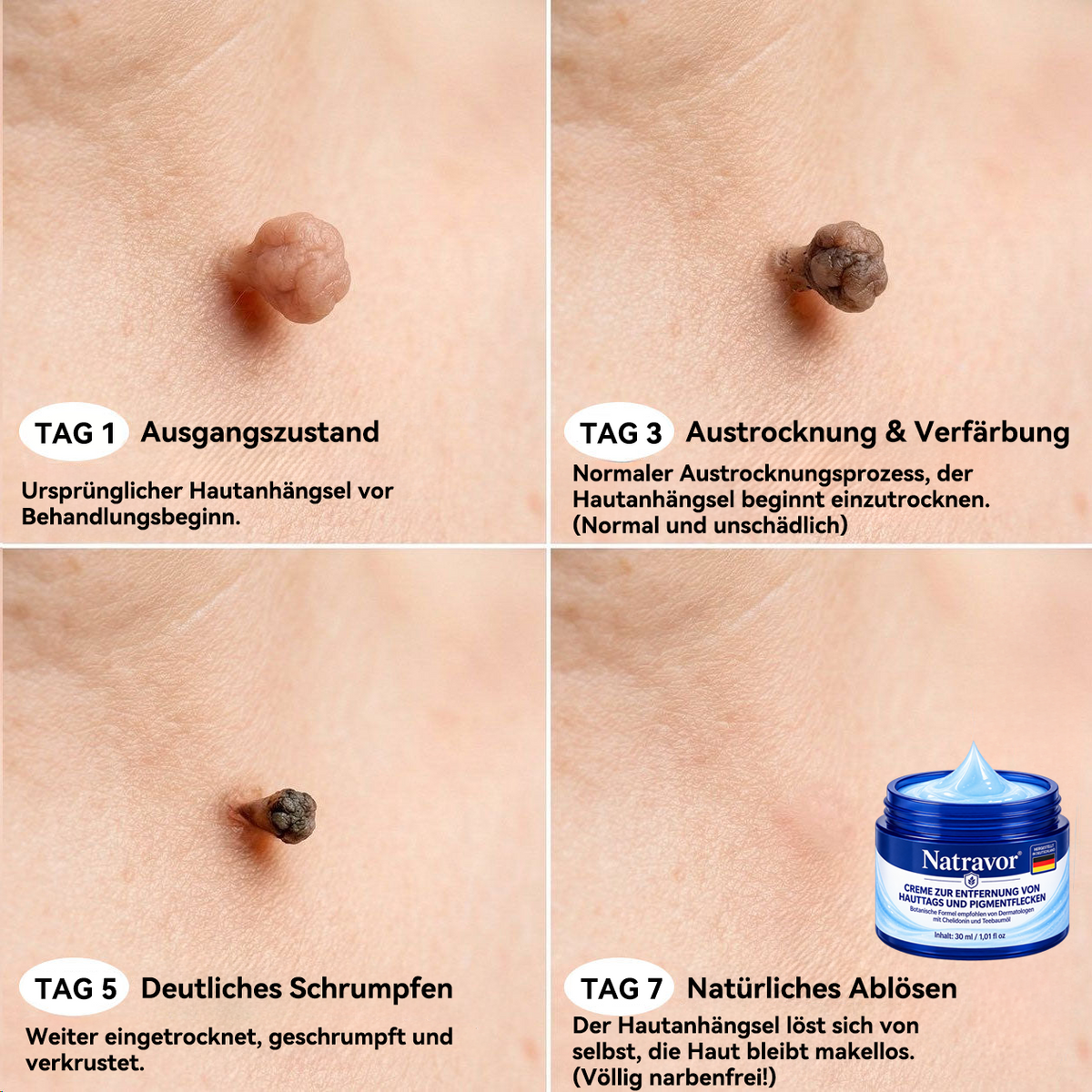 🔥 2. ARTIKEL 50 % RABATT! 🔥 Natravor® 7-Tage-Pflegecreme für Hautanhängsel & Hautflecken (𝐒𝐜𝐡𝐦𝐞𝐫𝐳𝐟𝐫𝐞𝐢𝐞 𝐅𝐨𝐫𝐦𝐞𝐥 – 𝐨𝐡𝐧𝐞 𝐍𝐚𝐫𝐛𝐞𝐧)