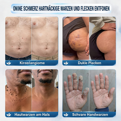 🔥 2. ARTIKEL 50 % RABATT! 🔥 Natravor® 7-Tage-Pflegecreme für Hautanhängsel & Hautflecken (𝐒𝐜𝐡𝐦𝐞𝐫𝐳𝐟𝐫𝐞𝐢𝐞 𝐅𝐨𝐫𝐦𝐞𝐥 – 𝐨𝐡𝐧𝐞 𝐍𝐚𝐫𝐛𝐞𝐧)